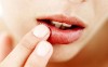  «Проявления герпетической инфекции на слизистой оболочке полости рта».